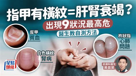 指甲凹|指甲凹陷、橫紋恐是肝腎出問題！8徵兆看出健康警訊